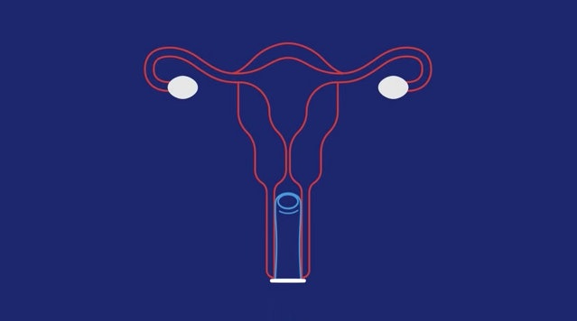 Female condoms Female condoms