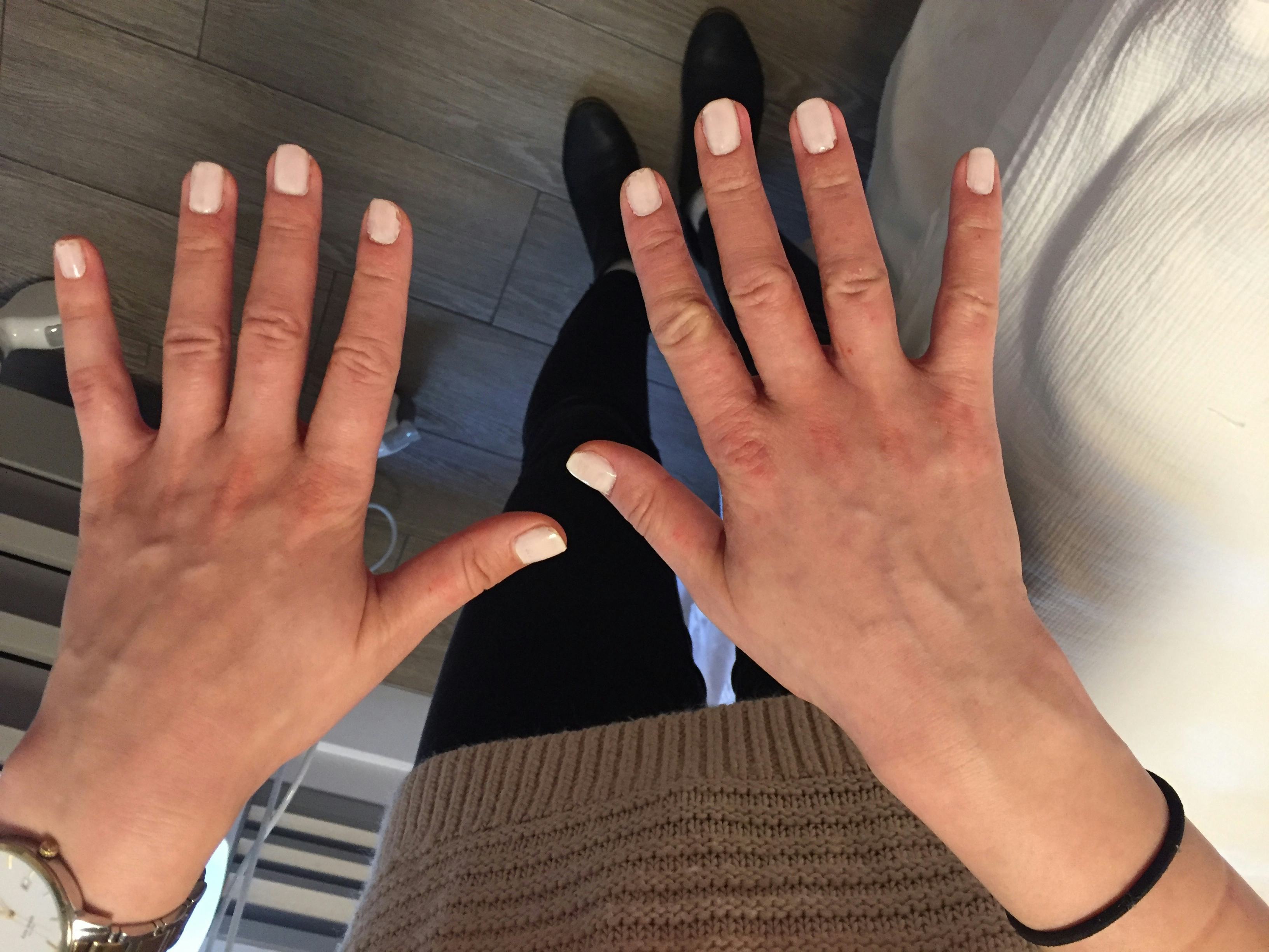 I Got A Skin Treatment To Make My Dry, Wrinkled Hands Look Younger