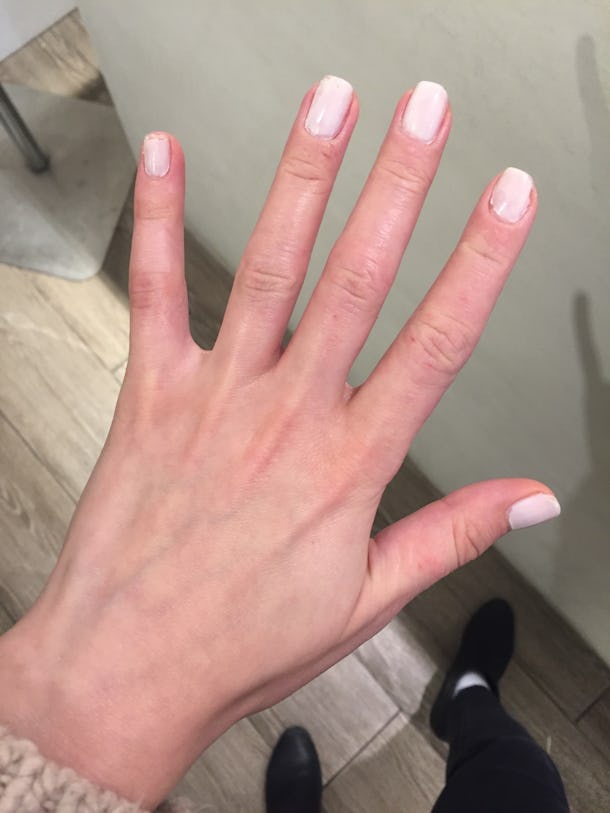 I Got A Skin Treatment To Make My Dry, Wrinkled Hands Look Younger