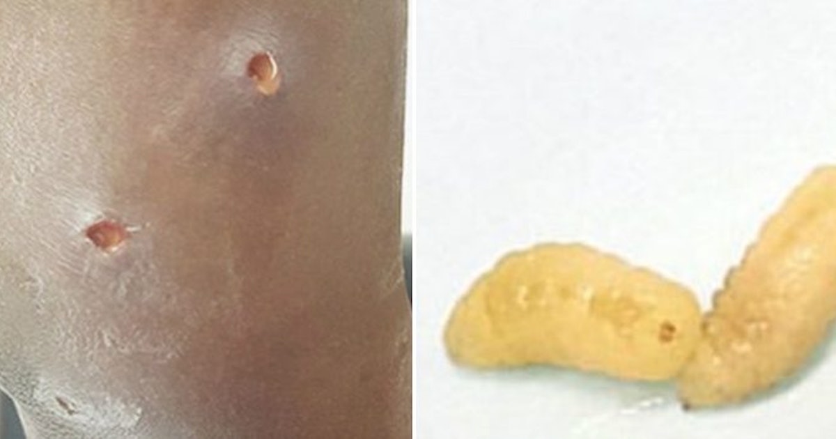 Woman Discovers Flesh-Eating Maggots Living Under Her Skin