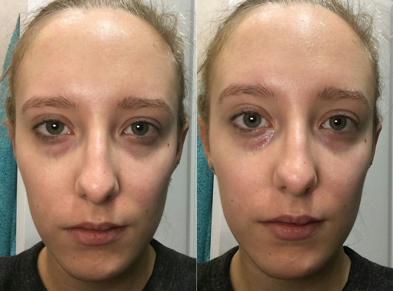Very swollen face in the morning. Because of which Very swollen face in the morning. Because of which