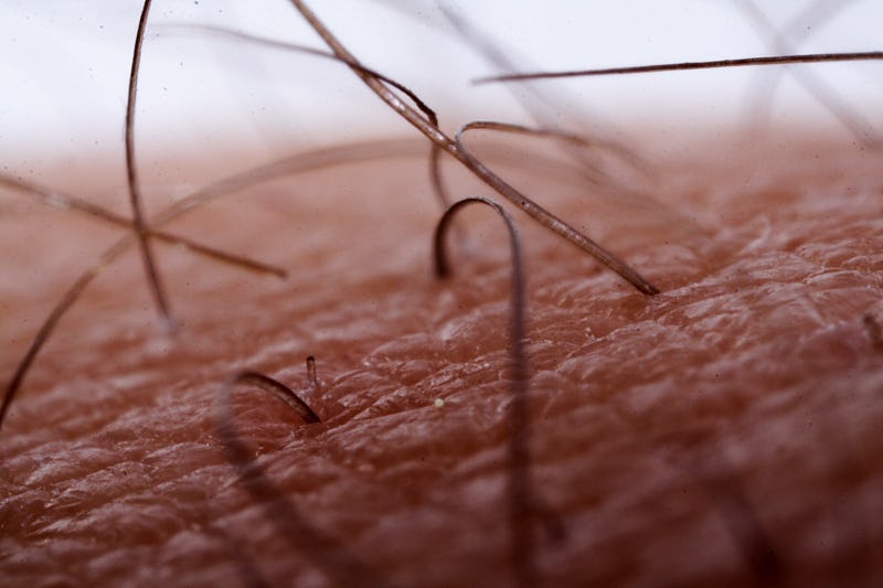 How To Remove An Ingrown Hair Quickly Easily And Without Any