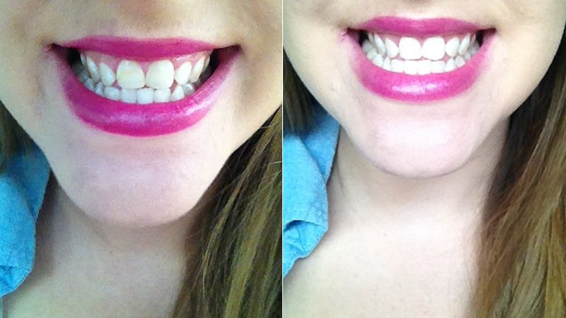 Tried At-Home Teeth Whitening Methods Pinterest Recommends To Get A 