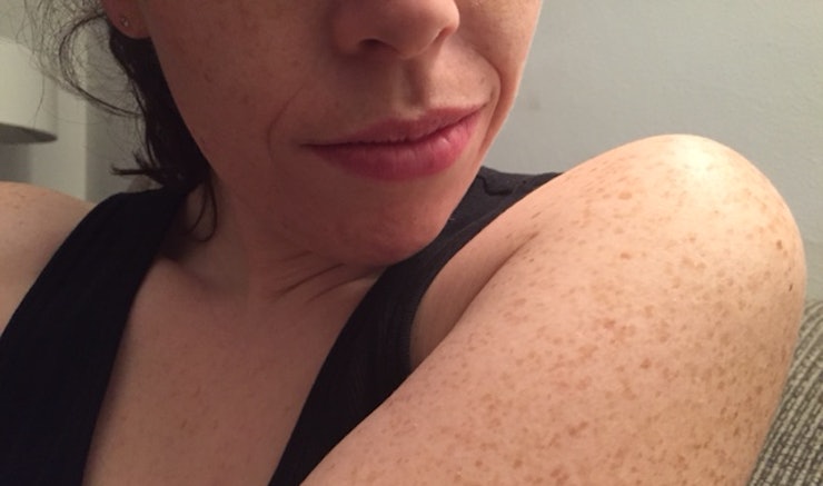 Keratosis Pilaris: Treat Those Bumps on the Back of Your ...