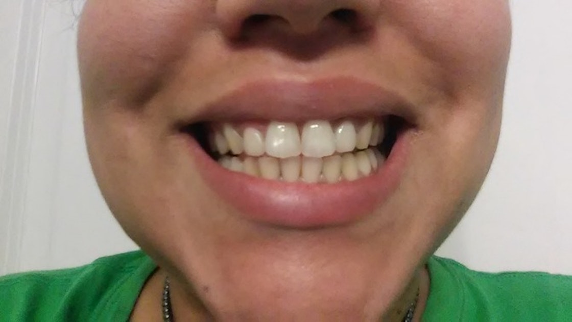 Does Activated Charcoal Whiten Teeth? I Brushed With It For A Week 