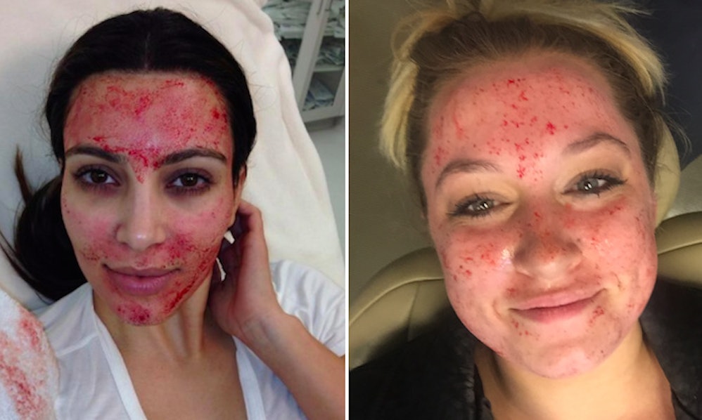 Does Microneedling Work? This Kardashian-Approved Skin Procedure