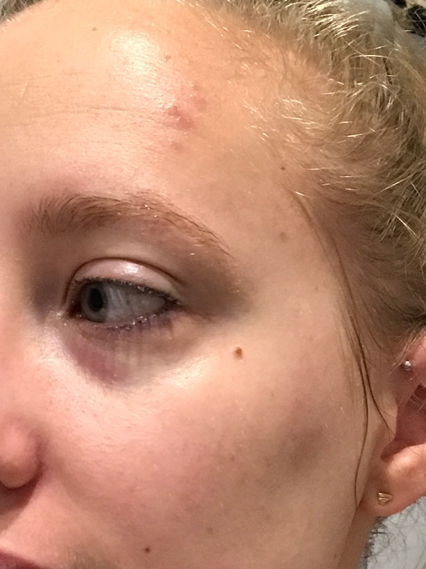 I Got A Chemical Peel For The First Time & Haven't Worn I Got A Chemical Peel For The First Time & Haven't Worn